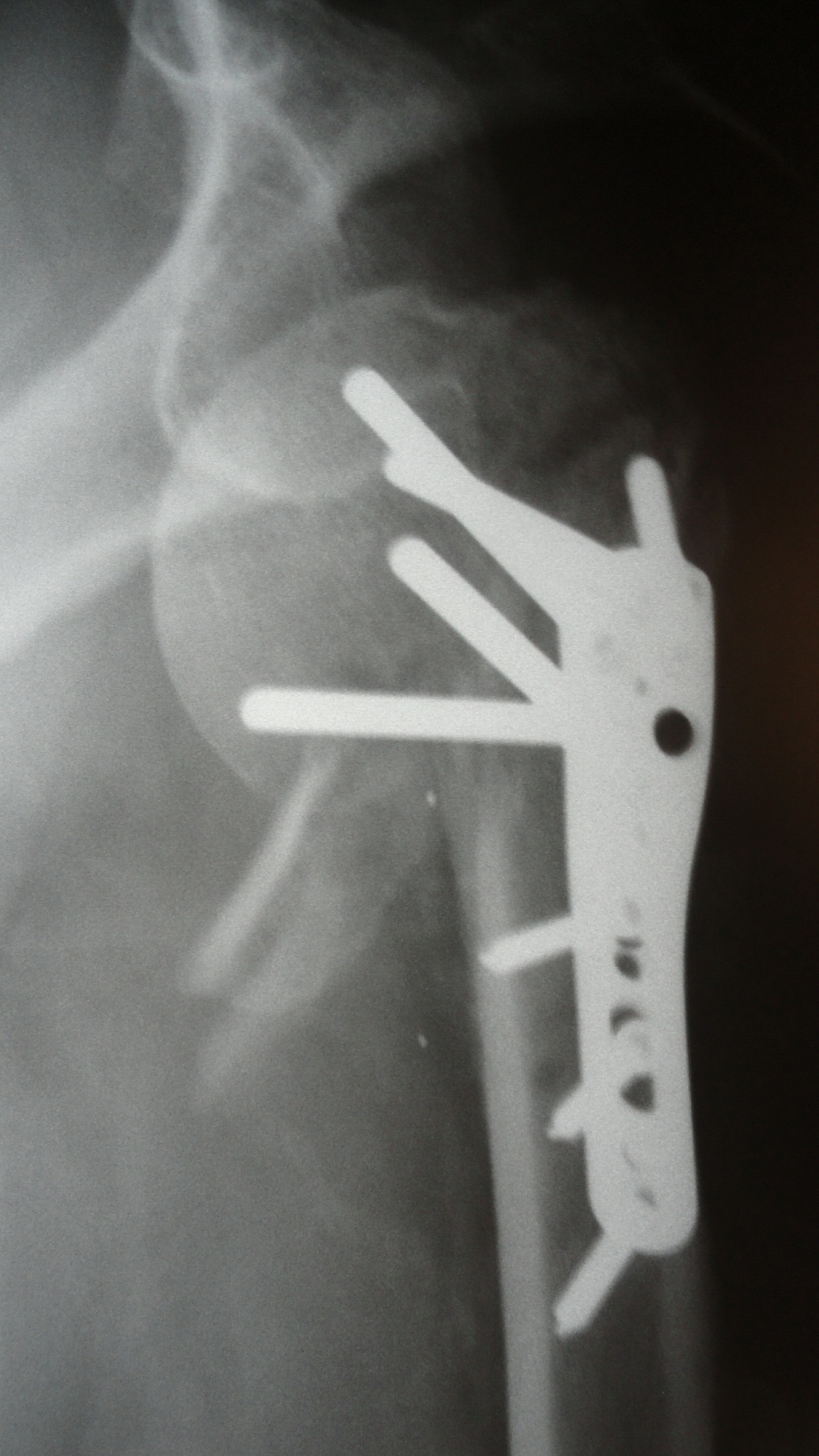 Dr. Steinbergâ€™s Reputation Made It Easy for Dr. Koster to Come Home to Jacksonville for Shoulder Surgery